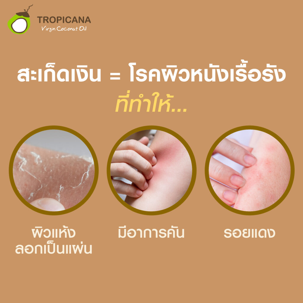 น้ำมันมะพร้าวสกัดเย็น ช่วยรักษาโรคผิวหนัง